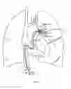 Fig. 08 - Thrombectomy catheter and methods of use