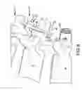 Fig. 07 - Spinal stabilization system with adjustable interlaminar devices