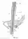 Fig. 41 - Spinal stabilization system with adjustable interlaminar devices