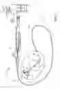Fig. 02 - Method of using time to effect (TTE) to estimate the optimum cryodose to apply to a pulmonary vein