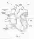 Fig. 02 - Adjustable prosthetic heart valve