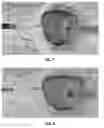 Fig. 05 - Actively controllable heart valve implant and method of controlling same