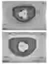Fig. 07 - Actively controllable heart valve implant and method of controlling same