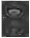 Fig. 14 - Actively controllable heart valve implant and method of controlling same