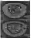 Fig. 21 - Actively controllable heart valve implant and method of controlling same