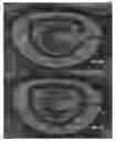 Fig. 22 - Actively controllable heart valve implant and method of controlling same
