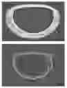 Fig. 30 - Actively controllable heart valve implant and method of controlling same