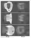 Fig. 32 - Actively controllable heart valve implant and method of controlling same