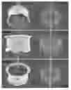 Fig. 33 - Actively controllable heart valve implant and method of controlling same