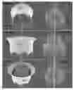 Fig. 34 - Actively controllable heart valve implant and method of controlling same