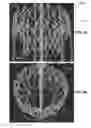 Fig. 37 - Actively controllable heart valve implant and method of controlling same