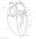 Fig. 01 - Device, system, and method for transcatheter treatment of valvular regurgitation
