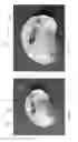 Fig. 41 - Device, system, and method for transcatheter treatment of valvular regurgitation