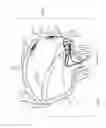 Fig. 74 - Device, system, and method for transcatheter treatment of valvular regurgitation