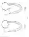 Fig. 90 - Device, system, and method for transcatheter treatment of valvular regurgitation
