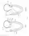 Fig. 92 - Device, system, and method for transcatheter treatment of valvular regurgitation