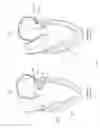 Fig. 97 - Device, system, and method for transcatheter treatment of valvular regurgitation