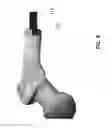 Fig. 06 - Modular megaprosthesis having a threaded stem and methods therefor