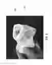 Fig. 07 - Modular megaprosthesis having a threaded stem and methods therefor