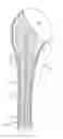 Fig. 01 - SHOULDER PROSTHESIS COMPONENT, SUCH AS A HUMERAL COMPONENT OR A GLENOID COMPONENT, FOR A PATIENT, AND METHOD FOR PRODUCING SUCH A SHOULDER PROSTHESIS COMPONENT FOR A PATIENT