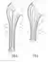 Fig. 03 - SHOULDER PROSTHESIS COMPONENT, SUCH AS A HUMERAL COMPONENT OR A GLENOID COMPONENT, FOR A PATIENT, AND METHOD FOR PRODUCING SUCH A SHOULDER PROSTHESIS COMPONENT FOR A PATIENT