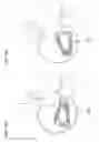 Fig. 16 - Expandable implant