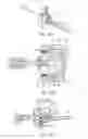 Fig. 10 - Bone graft delivery revolver