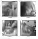 Fig. 13 - Hyperthermic vessel treatment devices and methods and kits utilizing the same