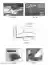Fig. 16 - Hyperthermic vessel treatment devices and methods and kits utilizing the same