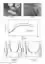 Fig. 18 - Hyperthermic vessel treatment devices and methods and kits utilizing the same