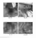 Fig. 23 - Hyperthermic vessel treatment devices and methods and kits utilizing the same