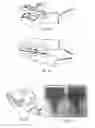 Fig. 25 - Hyperthermic vessel treatment devices and methods and kits utilizing the same