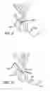 Fig. 09 - Eustachian tube dilation balloon with ventilation path