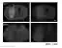 Fig. 01 - Malignant tumor target peptide