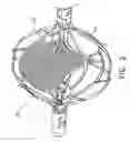 Fig. 03 - Ventricular assist device