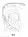Fig. 02 - Extractor for removing a lead from a patient