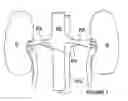 Fig. 02 - Methods and apparatus for bilateral renal neuromodulation