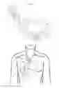 Fig. 02 - Methods and apparatus to inactivate infectious agents on a drainage catheter residing in a body cavity