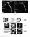 Fig. 22 - Quantitative imaging for detecting vulnerable plaque