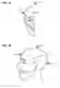 Fig. 02 - DETECTION OF CONCUSSION USING CRANIAL ACCELEROMETRY
