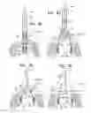 Fig. 08 - Implant for heart valve