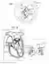 Fig. 12 - Implant for heart valve