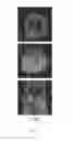 Fig. 13 - Long-lived gadolinium based tumor targeting imaging and therapy agents