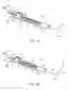 Fig. 02 - GUIDEWIRE ASSEMBLY WITH OFFSET CORE WIRES