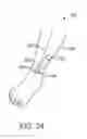 Fig. 15 - Miniature implantable neurostimulator system for sciatic nerves and their branches
