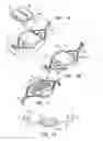 Fig. 02 - RETINAL IMPLANT FIXATION