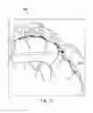 Fig. 11 - Devices systems and methods for assessment of vessels