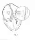 Fig. 04 - Device and procedure for pericardial patch transcatheter atrial septal defect closure