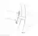 Fig. 05 - Device and procedure for pericardial patch transcatheter atrial septal defect closure