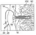 Fig. 01 - Systems for locking a cinch loop in tissue repair